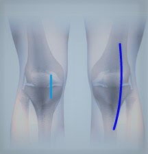 mis knee2